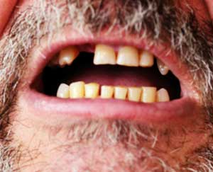 Dream of Teeth falling out